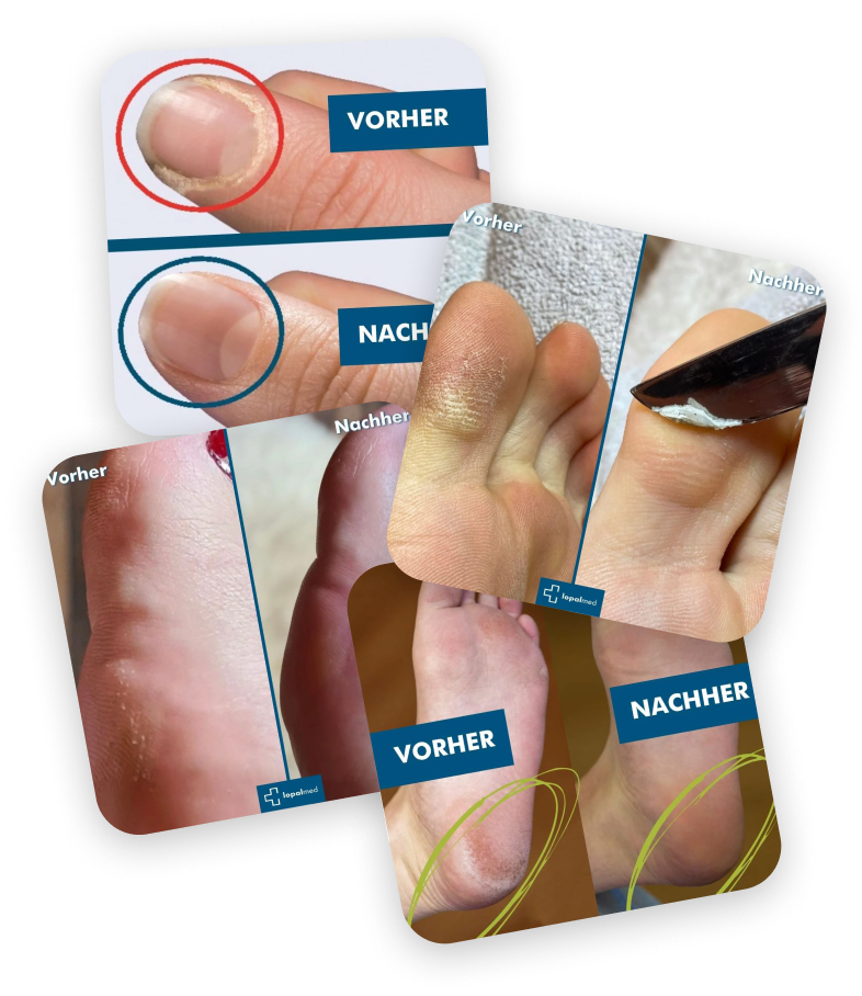 Vorher Nachher Effekt von Lopalmed