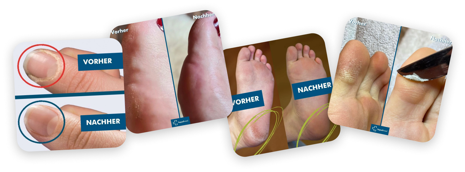 Vorher Nachher Effekt von Lopalmed